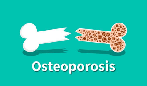 Ostheoporosis